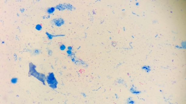 Smear of sputum from a tuberculosis patient showing blue and red patterns. 