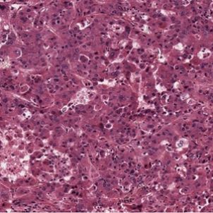 Photo of Novel Drug Targets & Cell Line for Hepatocellular Carcinoma