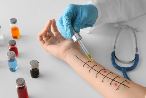 Skin prick test Skin prick test