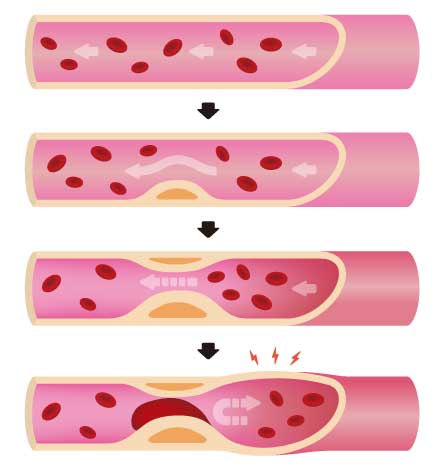 progression of arteriosclerosis. 