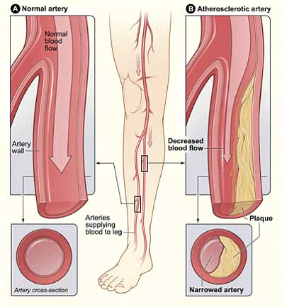 healthy artary vs narrowed artery