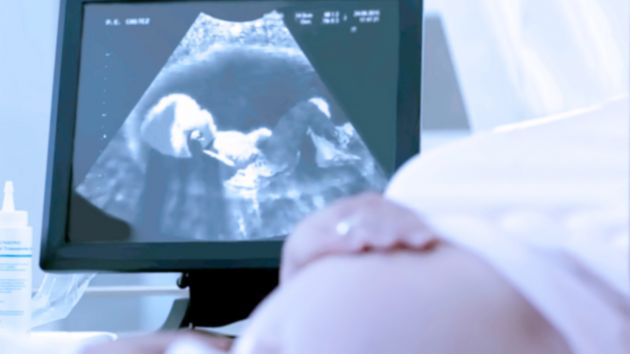 Image of baby in an ultrasound scan with pregnant mother's stomach in foreground