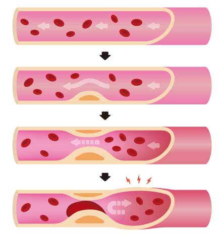 progression of arteriosclerosis.