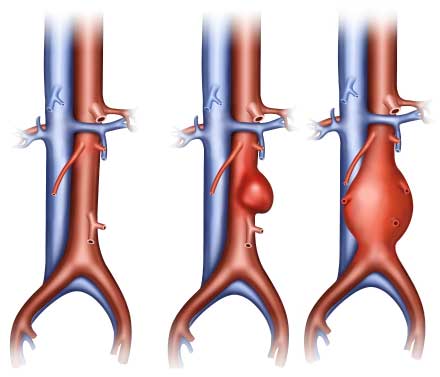 different types of abdominal aortic aneurysm.