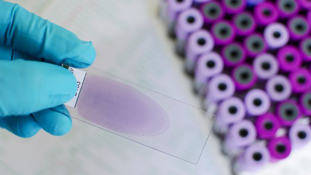 Researcher doing a malaria test
